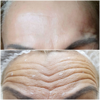 активна лобна міміка