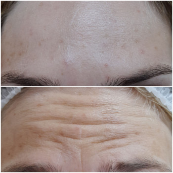 Ботулінотерапія верхньої третини обличчя
                    Косметолог Ірина Луцк