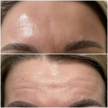 Ботулінотерапія верхньої третини обличчя
                    Косметолог Ірина Луцк