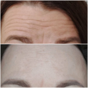 Ботулінотерапія верхньої третини обличчя
                    Косметолог Ірина Луцк