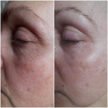 Карбоксітерапія
                    Косметолог Ірина Луцьк