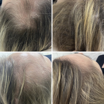 Відновлення росту волосся