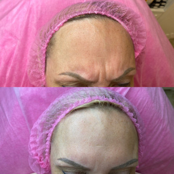 Ботокс
                    Косметолог Евгения Кривой Рог