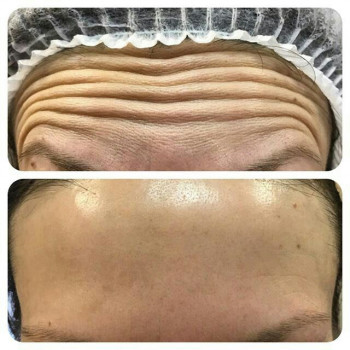 Ботокс
                    Косметолог Евгения Кривой Рог