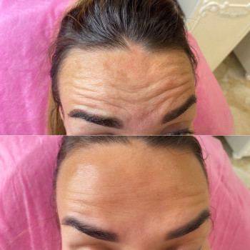 Ботокс
                    Косметолог Евгения Кривой Рог