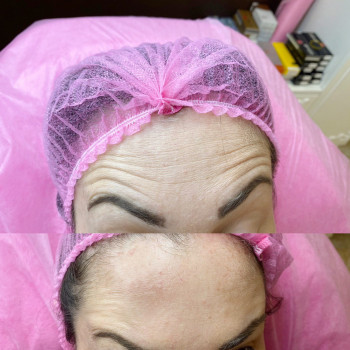 Ботокс
                    Косметолог Евгения Кривой Рог