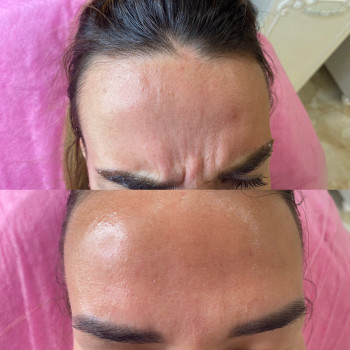 Ботокс
                    Косметолог Евгения Кривой Рог