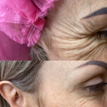 Ботокс
                    Косметолог Евгения Кривой Рог