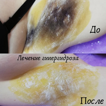 Ботокс
                    Косметолог Евгения Кривой Рог