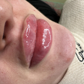 Контурна пластика губ