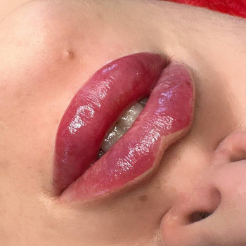 Контурна пластика губ