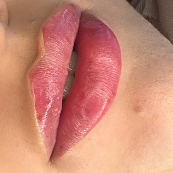 Контурна пластика губ