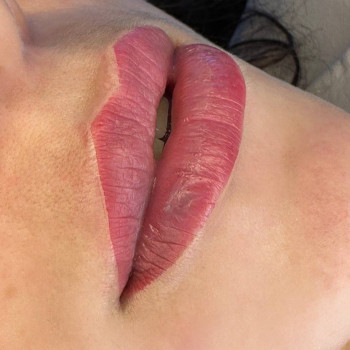 Контурна пластика губ