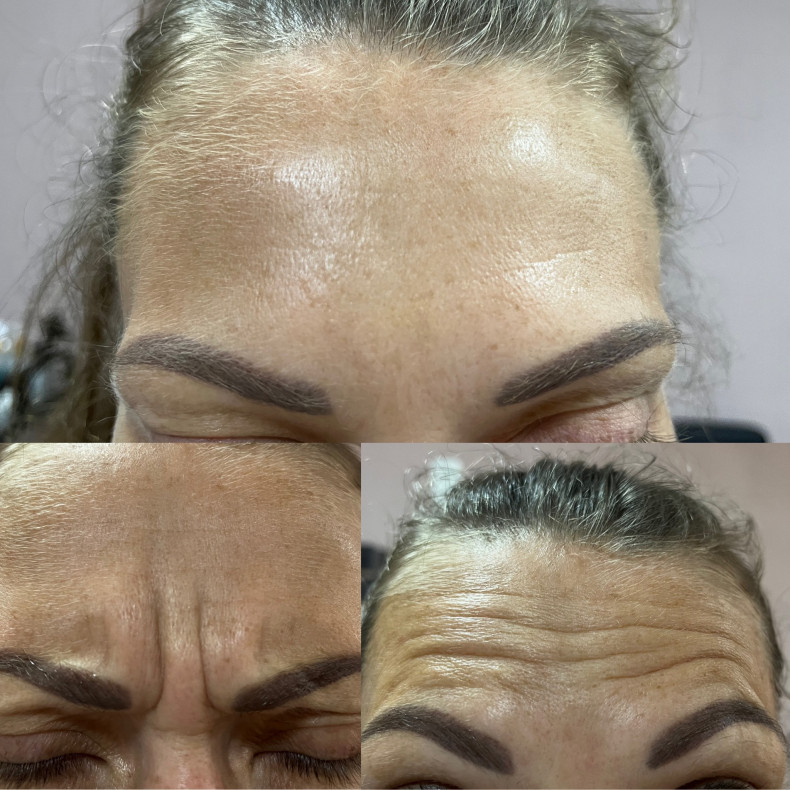 Морщины ботокс, фото - Косметолог Виктория Горлова