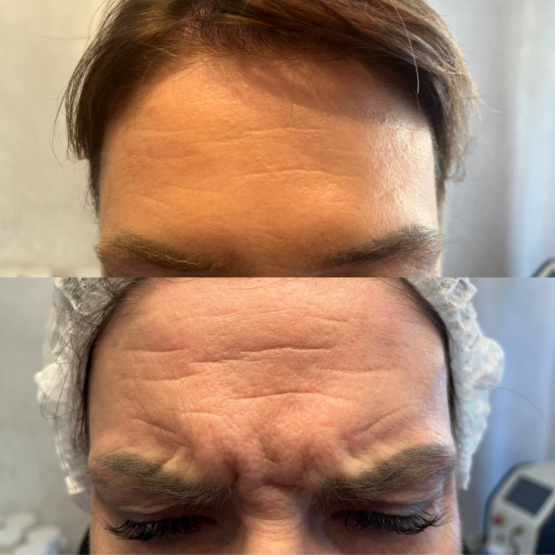 Морщины ботокс, фото - Косметолог Виктория Горлова