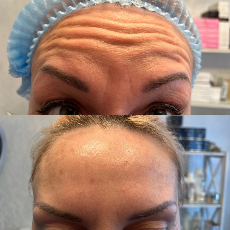 Морщины ботокс, фото - Косметолог Виктория Горлова