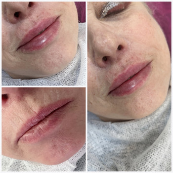   губ 
  кісетних зморшок