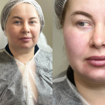 Радієс radiesse, фото - косметолог-ін'єкціоніст Аліна Жостка