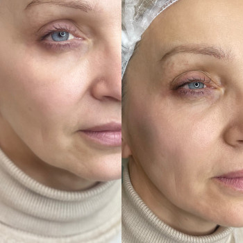 Радієс radiesse, фото - косметолог-ін'єкціоніст Аліна Жостка