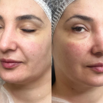 Радієс radiesse, фото - косметолог-ін'єкціоніст Аліна Жостка