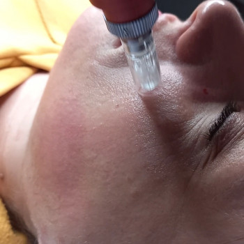 Мікронідлінг