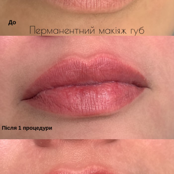  #збільшеннягуб #аугментаціягуб #збільшеннягубмако #філеригуби, фото -  
