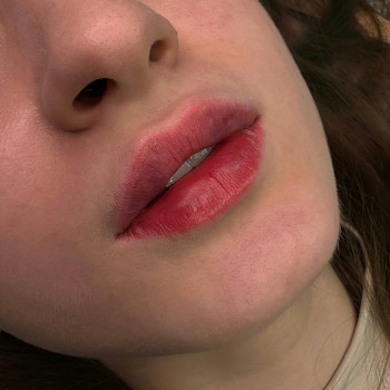 Увеличение губ, контурная пластика губ
                    Бровіст Олена Олександрія