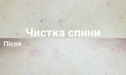 Чистка спини Косметолог Ксенія Ужгород