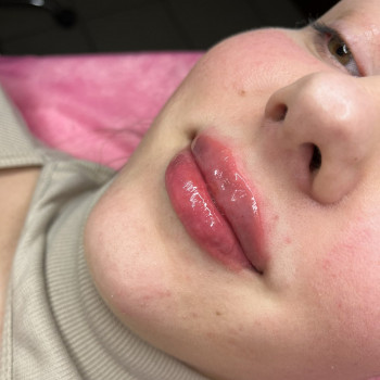 Контурна пластика губ,косметологиня Ольга,Київ