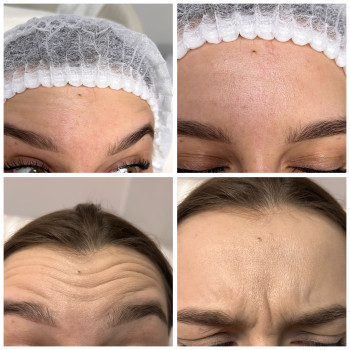 Ботулінотерапія
                    Дерматолог косметолог Юлия Біла Церква