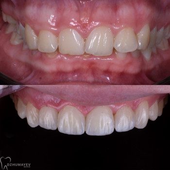 Художня реставрація, фото - стоматолог Вепа Джумаев