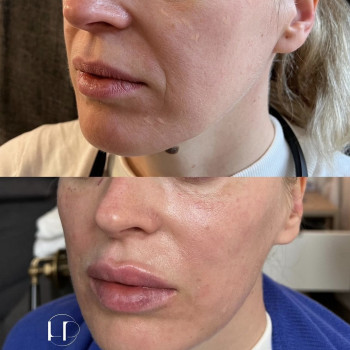 Ліфтинг середньої і нижньої третини обличчя.