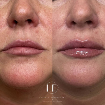 Корекція губ