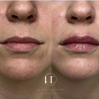 Корекція губ