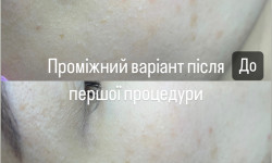 Видалення міліумів Косметолог Ксенія Ужгород