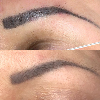 Нижнє фото - результат однієї процедури видалення