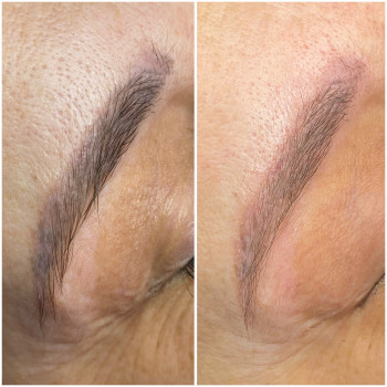 До/після,загоєні,друга процедура видалення