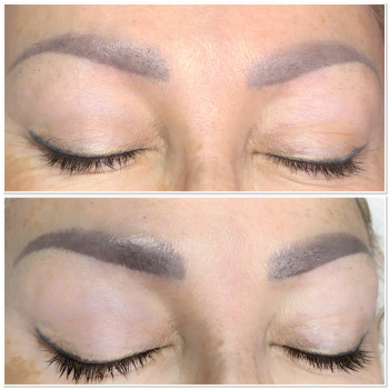 Перше фото загоєні після двох процедур видалення,друге фото до.