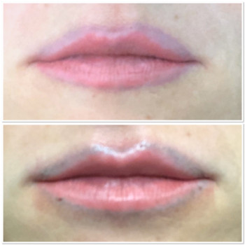 До і одразу після видалення ПМ губ