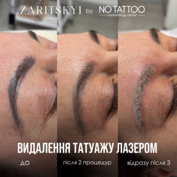 Видалення татуажу брів