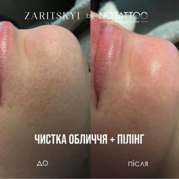 Чистка + пілінг