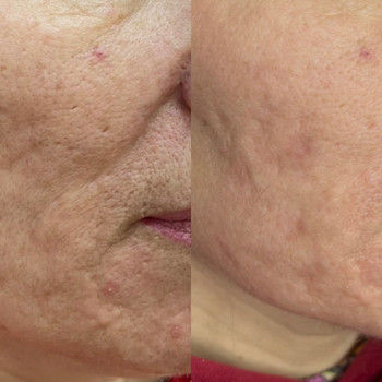 лазерна шліфовка обличчя