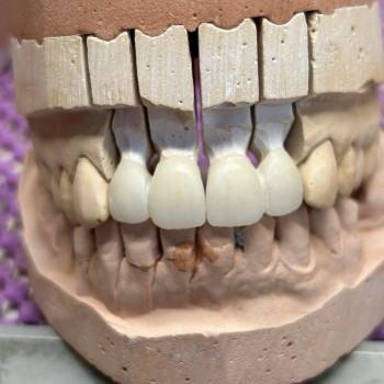 Протезування коронками, містками
                    Стоматолог-хірург Олександр Львів