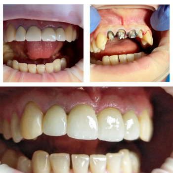 Протезування коронками, містками
                    Стоматолог-хірург Олександр Львів