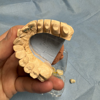 Протезування коронками, містками
                    Стоматолог-хірург Олександр Львів