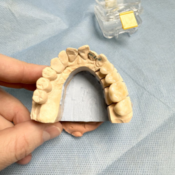 Протезування коронками, містками
                    Стоматолог-хірург Олександр Львів