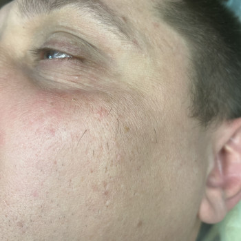 Электроэпиляция
                    Майстер депіляції Оксана Одеса