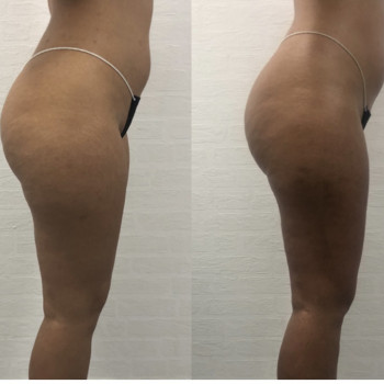 Курс из 5 массажей и 5 обертываний.