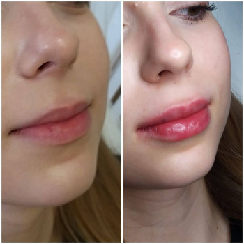 Збільшення губ.