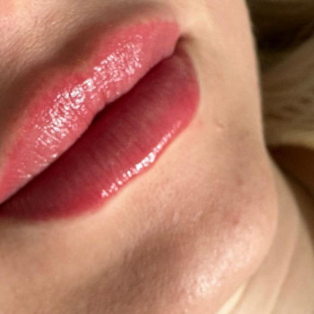 Збільшення губ